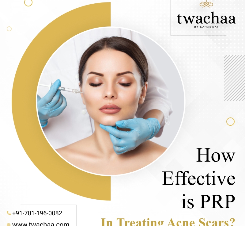 How PRP can be Useful in Treating Acne Scars?